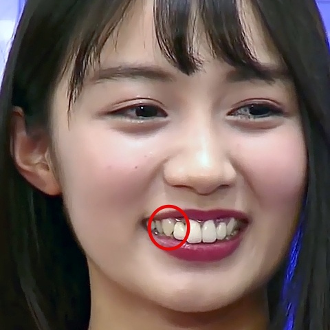 歯列矯正後の黒木ひかり