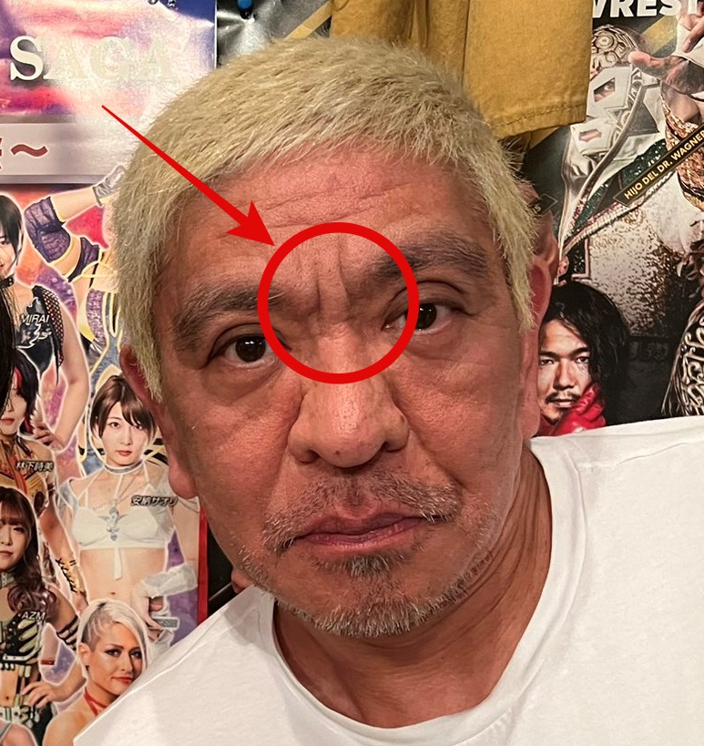 松本人志の眉間のシワ