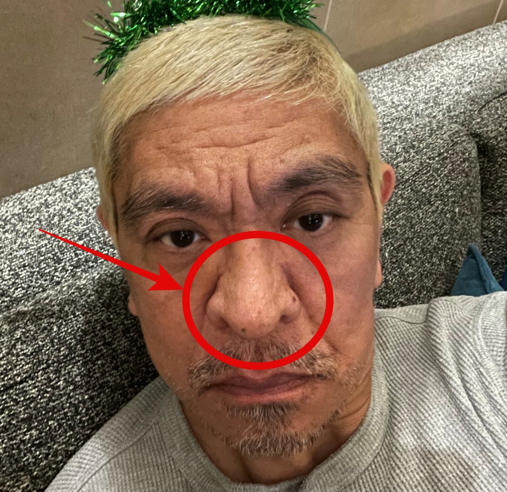 松本人志の鼻