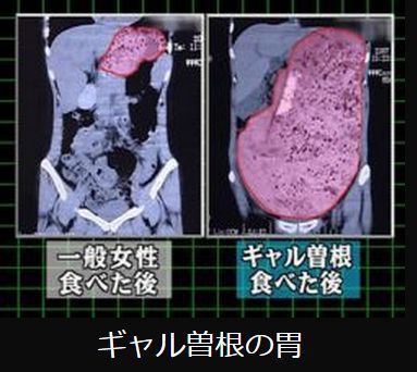 ギャル曽根の胃のレントゲン画像