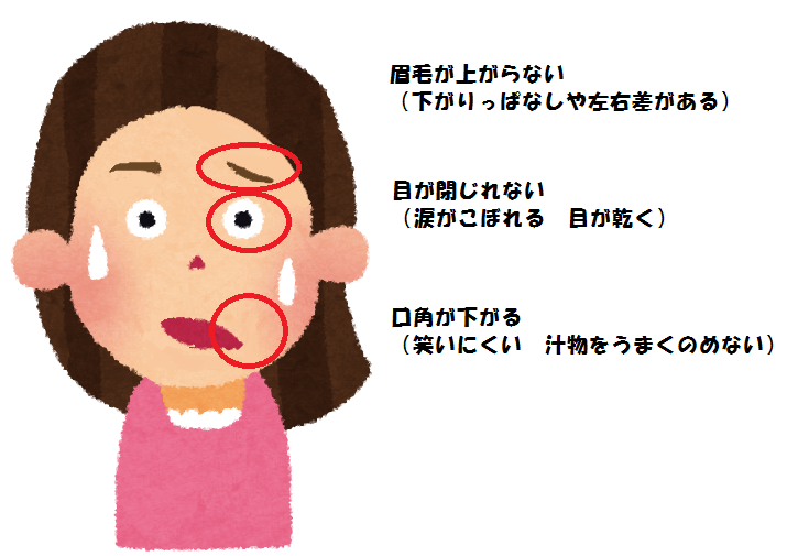 顔面麻痺の症状
